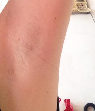 激光脱毛的价格380元,激光脱毛图片分享