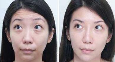 抬头纹手术多少钱？去抬头纹前后对比图