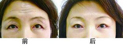 抬头纹手术多少钱？去抬头纹前后对比图