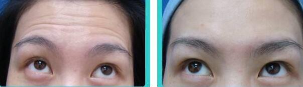 抬头纹手术多少钱？去抬头纹前后对比图