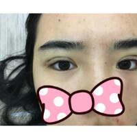 埋线双眼皮恢复日志多对比图分享