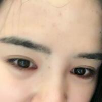 埋线双眼皮恢复日志多对比图分享