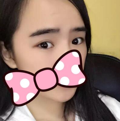 埋线双眼皮恢复日志多对比图分享