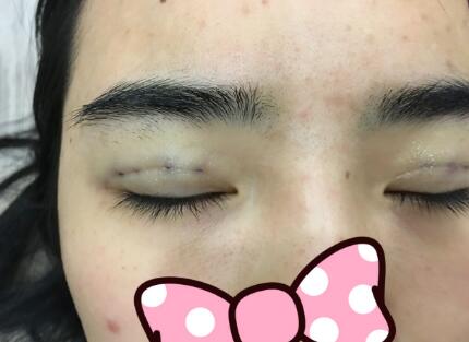 埋线双眼皮恢复日志多对比图分享