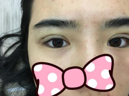 埋线双眼皮恢复日志多对比图分享