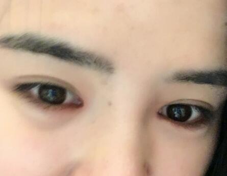 埋线双眼皮恢复日志多对比图分享