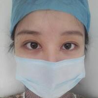 见证全切双眼皮使单眼皮变双眼皮的奇迹~恢复过程图分享