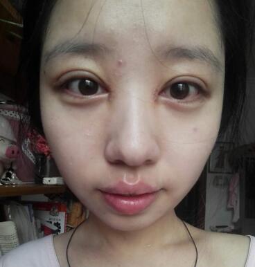 见证全切双眼皮使单眼皮变双眼皮的奇迹~恢复过程图分享