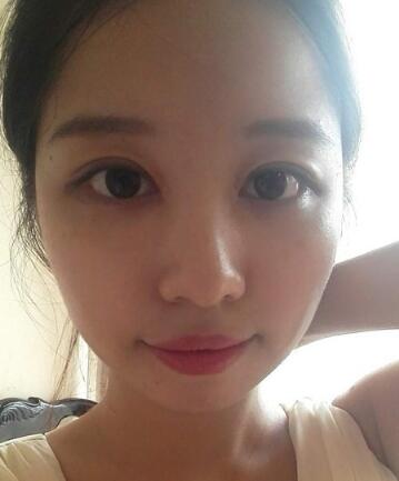 见证全切双眼皮使单眼皮变双眼皮的奇迹~恢复过程图分享