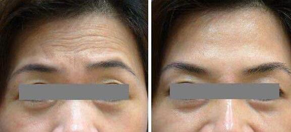去抬头纹前后对比图，去抬头纹手术多少钱？