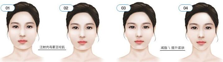 瘦脸前后对比图,B****的价格曝光