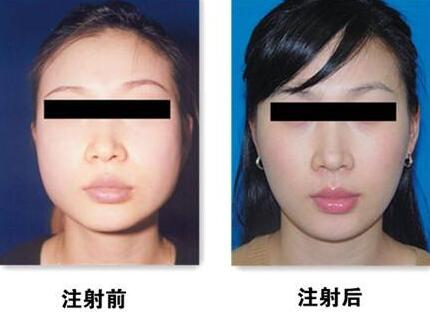 瘦脸前后对比图,B****的价格曝光