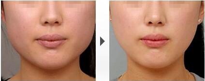 瘦脸前后对比图,B****的价格曝光