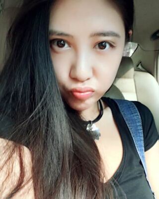 贵阳丽都自体脂肪面部填充+双下巴吸脂恢复图片