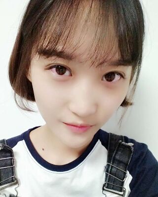 微创全切双眼皮果对比照片，贵阳丽都葛志鑫手术案例