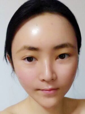 太原美莱全脸脂肪填充+自体脂肪丰胸恢复果图