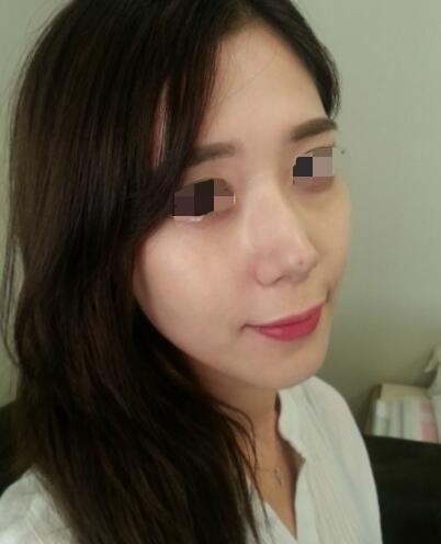 果酸嫩肤多少钱？我做成890元，果图分享给大家