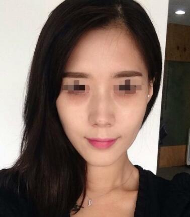 果酸嫩肤多少钱？我做成890元，果图分享给大家