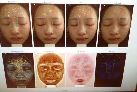 有人做过光子嫩肤吗？自己做过，感觉果不错分享