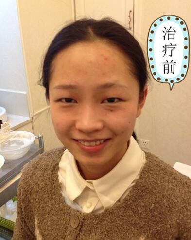 有人做过光子嫩肤吗？自己做过，感觉果不错分享