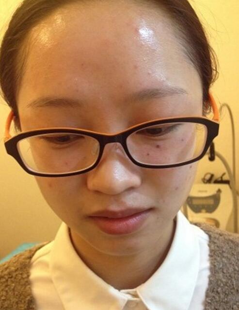 有人做过光子嫩肤吗？自己做过，感觉果不错分享