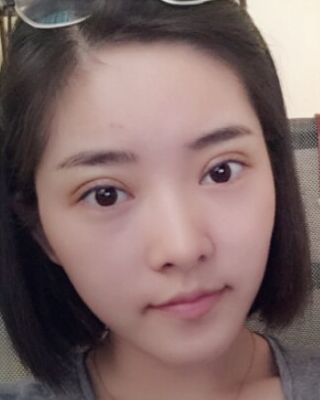 全切微创双眼皮恢复图，长沙希美蒋松林手术案例