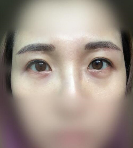 龙岩华美张长山做的眉下提升恢复果案例图