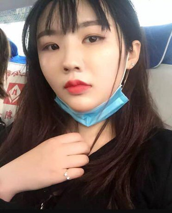 武汉美亚金国华医生帮我做的自体脂肪全脸填充果恢复案例