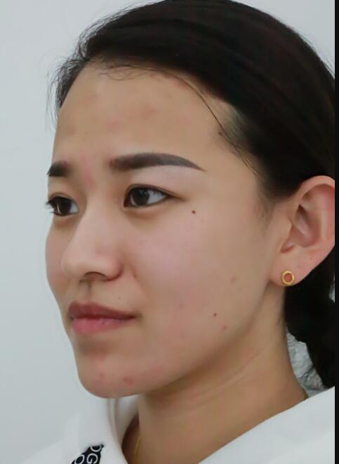 注射瘦脸去抬头纹眉间纹恢复过程图，真实案例分享