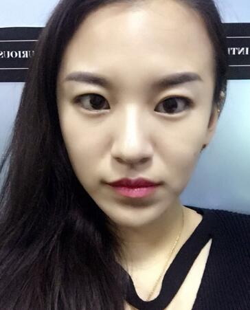 注射瘦脸去抬头纹眉间纹恢复过程图，真实案例分享