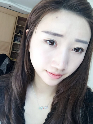 潍坊华美童艳梅医生做的面部脂肪填充，大家来看看果怎么样