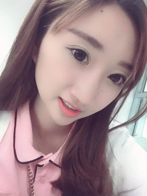 潍坊华美童艳梅医生做的面部脂肪填充，大家来看看果怎么样