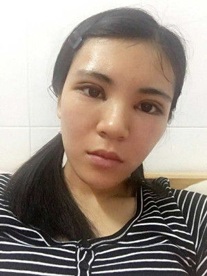 青海康华马晶医生切开双眼皮真实案例分享