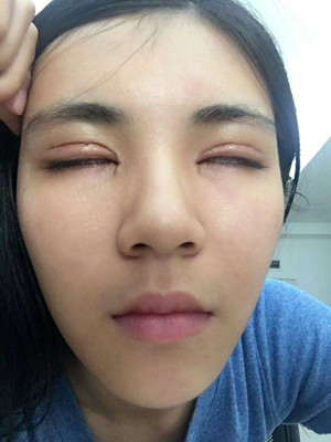 青海康华马晶医生切开双眼皮真实案例分享