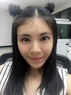 青海康华马晶医生切开双眼皮真实案例分享