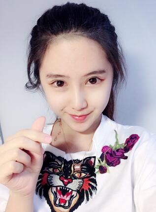 成都美未央隆鼻整形手术恢复日记图