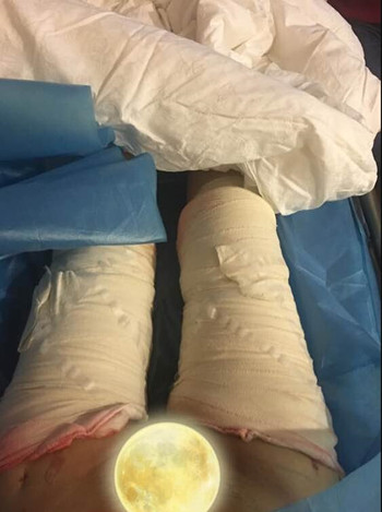 广州美莱罗延平做的大腿环吸整形恢复果过程案例