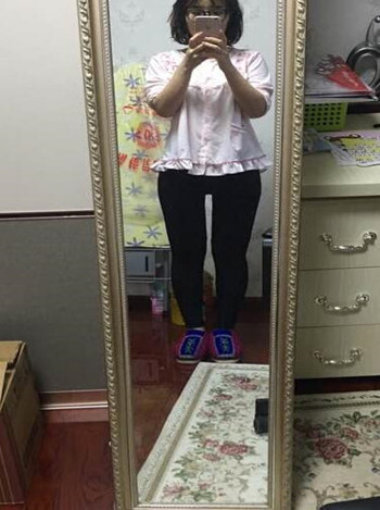 广州美莱罗延平做的大腿环吸整形恢复果过程案例