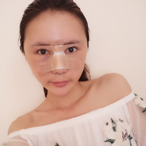 济南海峡赵广生做的自体耳软骨垫鼻尖+硅胶隆鼻前后对比照片分享