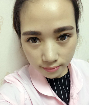 济南海峡谢燕燕做的切开双眼皮，分享前后对比照片以及恢复过程