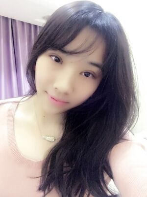 洛阳孔繁荣切开双眼皮+开眼角手术恢复过程图