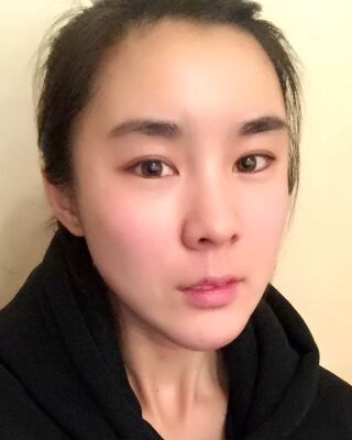 自体脂肪面部填充三个月果图分享，减龄十岁