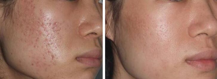 去痘印医院哪家好