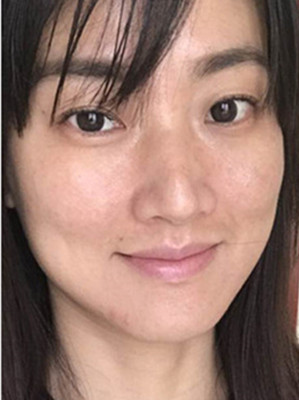 济南爱容路传燕医生做的激光去黄褐斑，大家快来看看果如何
