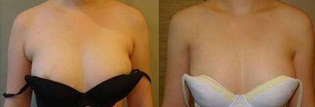 副乳切除前后对比果图,副乳手术需要多少钱?