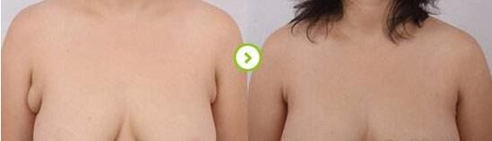 副乳切除前后对比果图,副乳手术需要多少钱?