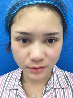 洛阳维多利亚欧式双眼皮手术恢复过程图，真实案例图