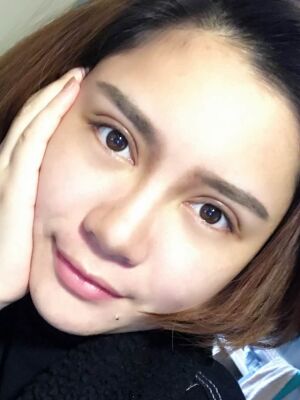 洛阳维多利亚欧式双眼皮手术恢复过程图，真实案例图