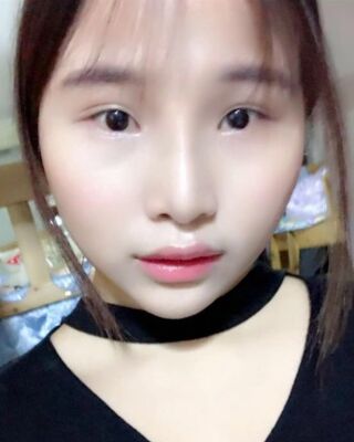 仇侃敏韩式隆鼻整形恢复果对比照片