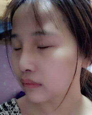 仇侃敏韩式隆鼻整形恢复果对比照片